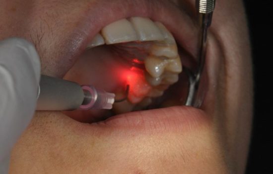 Painless laser dental treatment