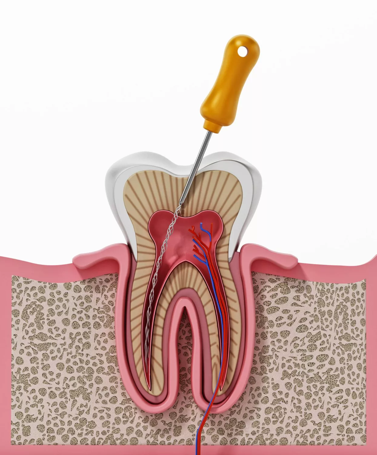 Dental X-ray showing root canal