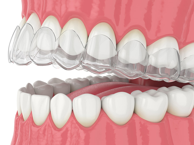 Invisible Braces and Orthodontics in Bangalore