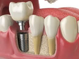 Titanium Dental Implant Procedure