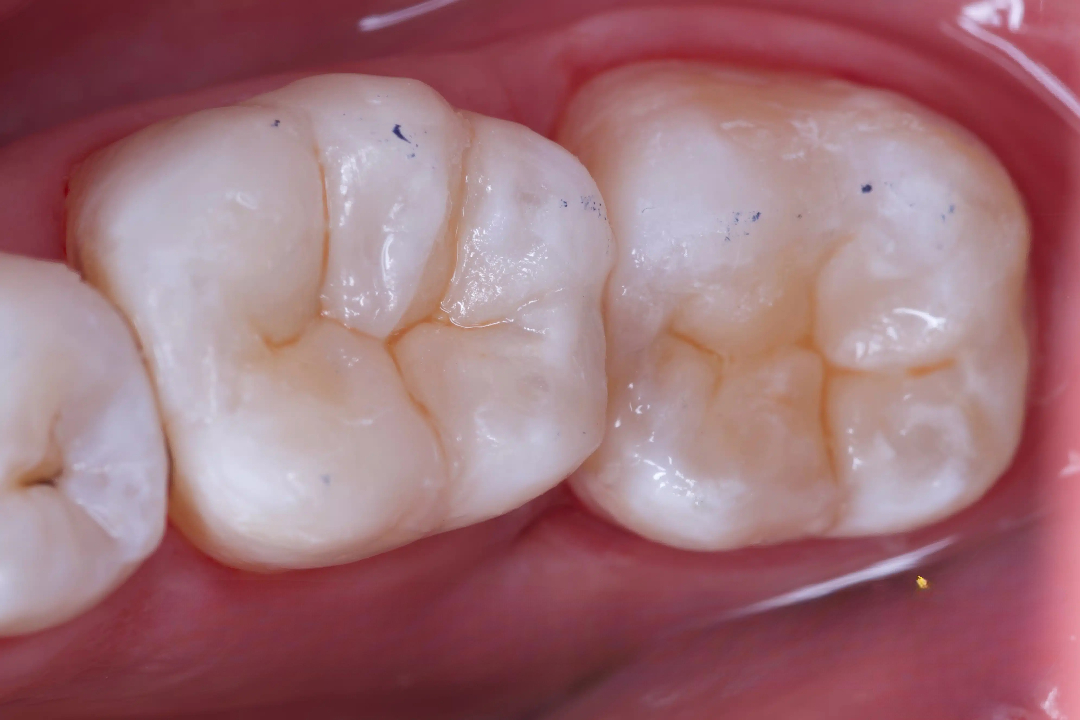 Composite filling application