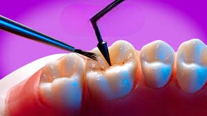 Tooth Coloured Dental Fillings in Rajarajeshwari Nagar