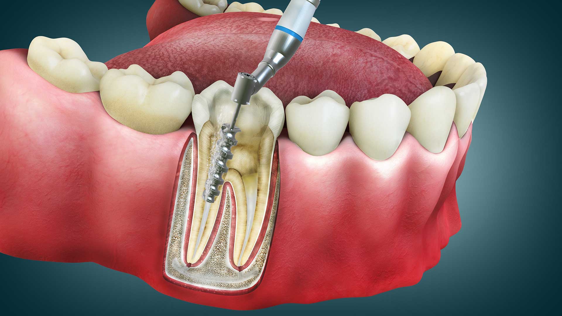 Painless Root Canal Treatment in RR Nagar Bangalore