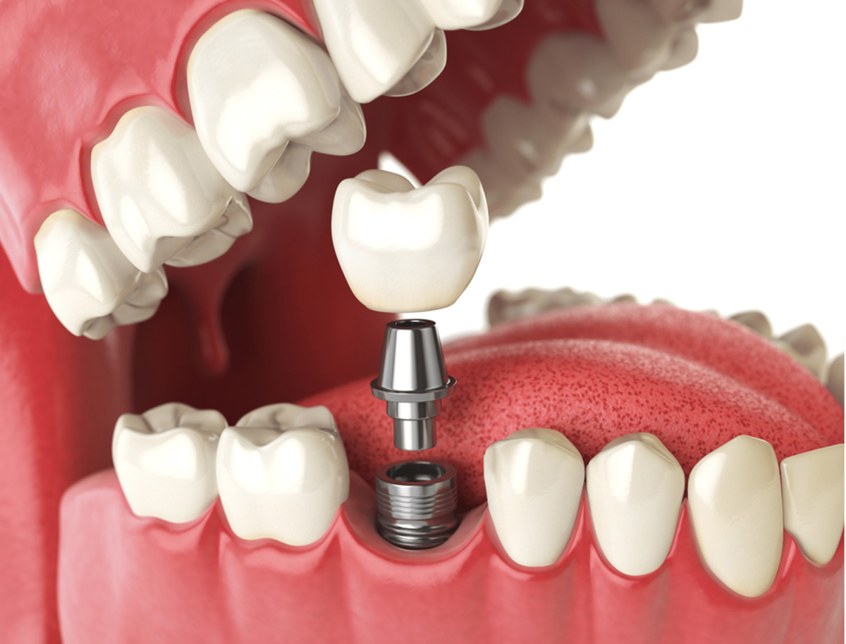 Dental Implants Bangalore