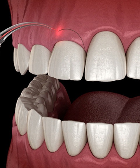 Gummy Smile Correction Bangalore