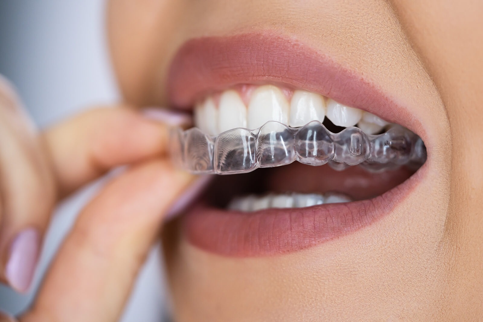 Dental Braces close up
