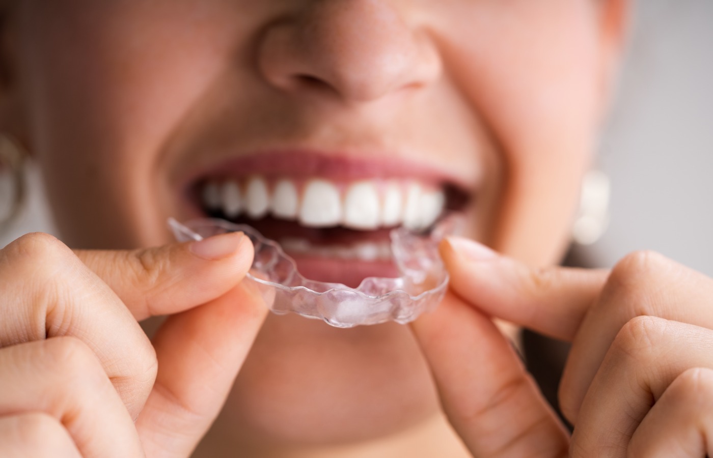 Orthodontic Braces Treatment Bangalore