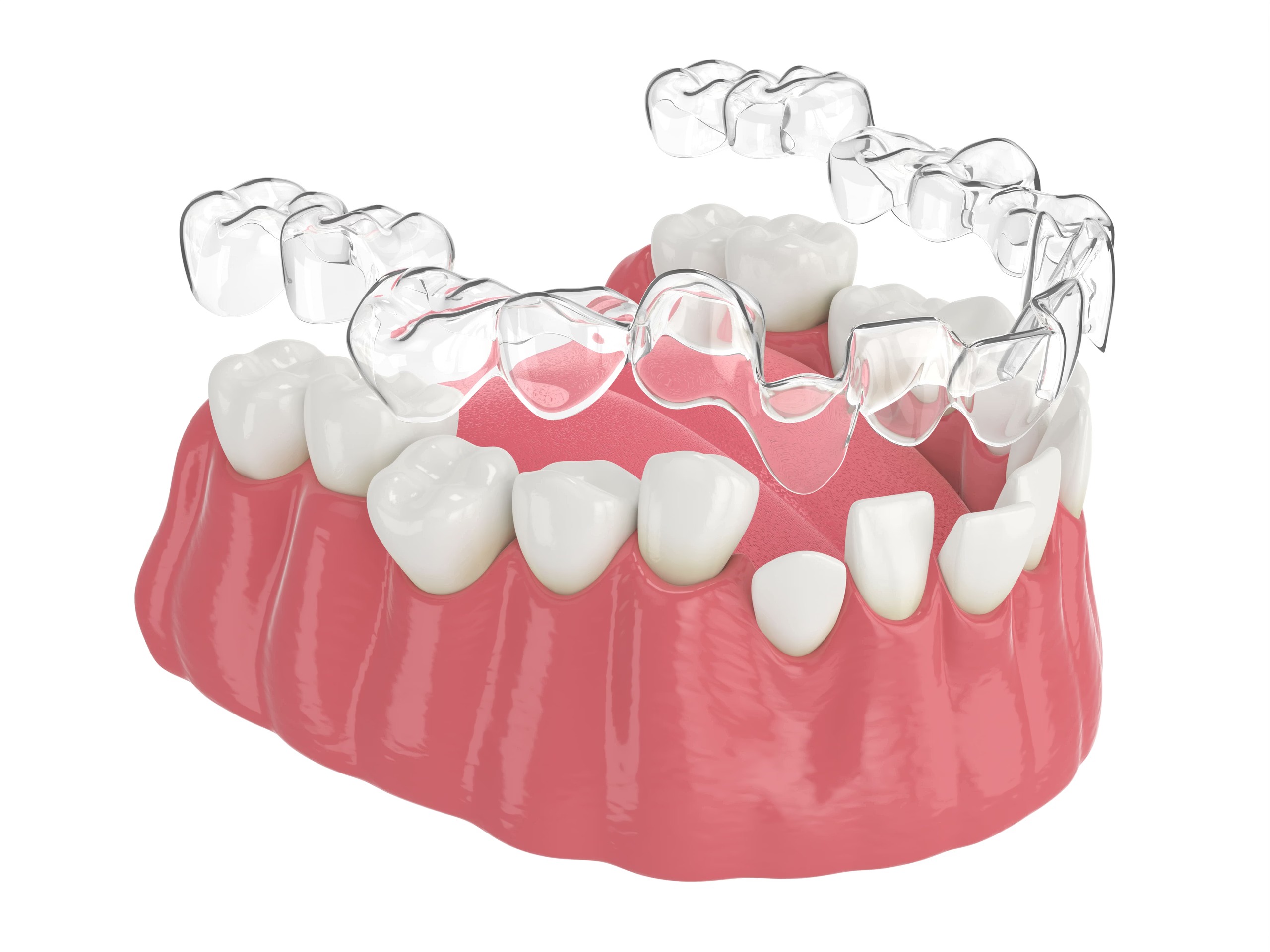 Dental Braces Treatment in Bangalore