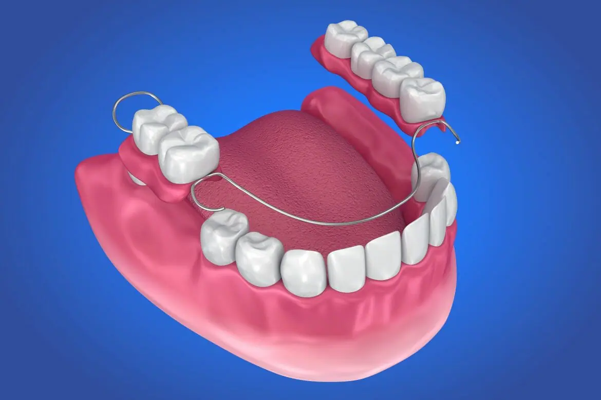 Modern Custom Dentures Bangalore