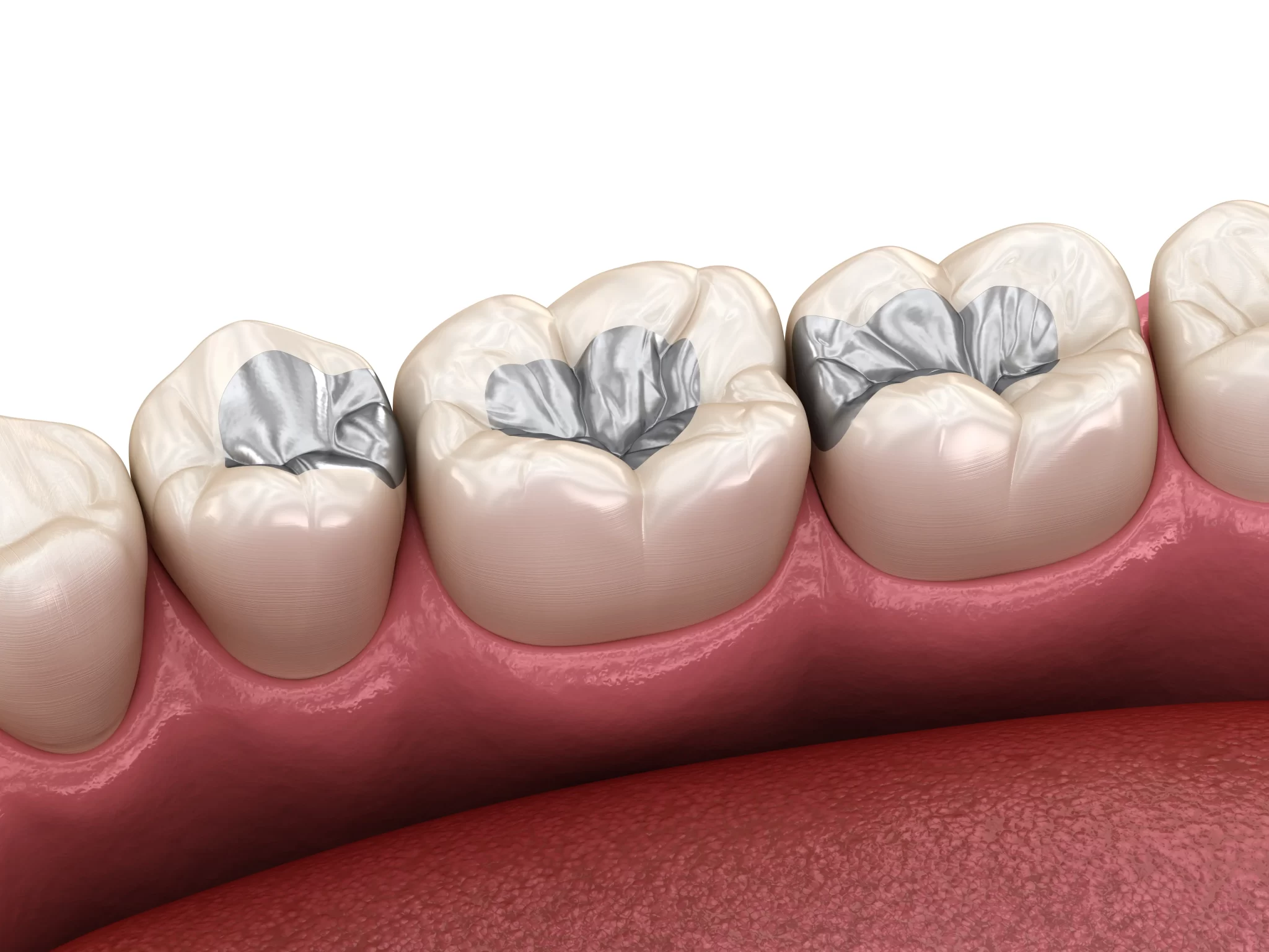 Tooth Cavity Fillings Bangalore
